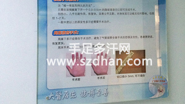 手汗症说明